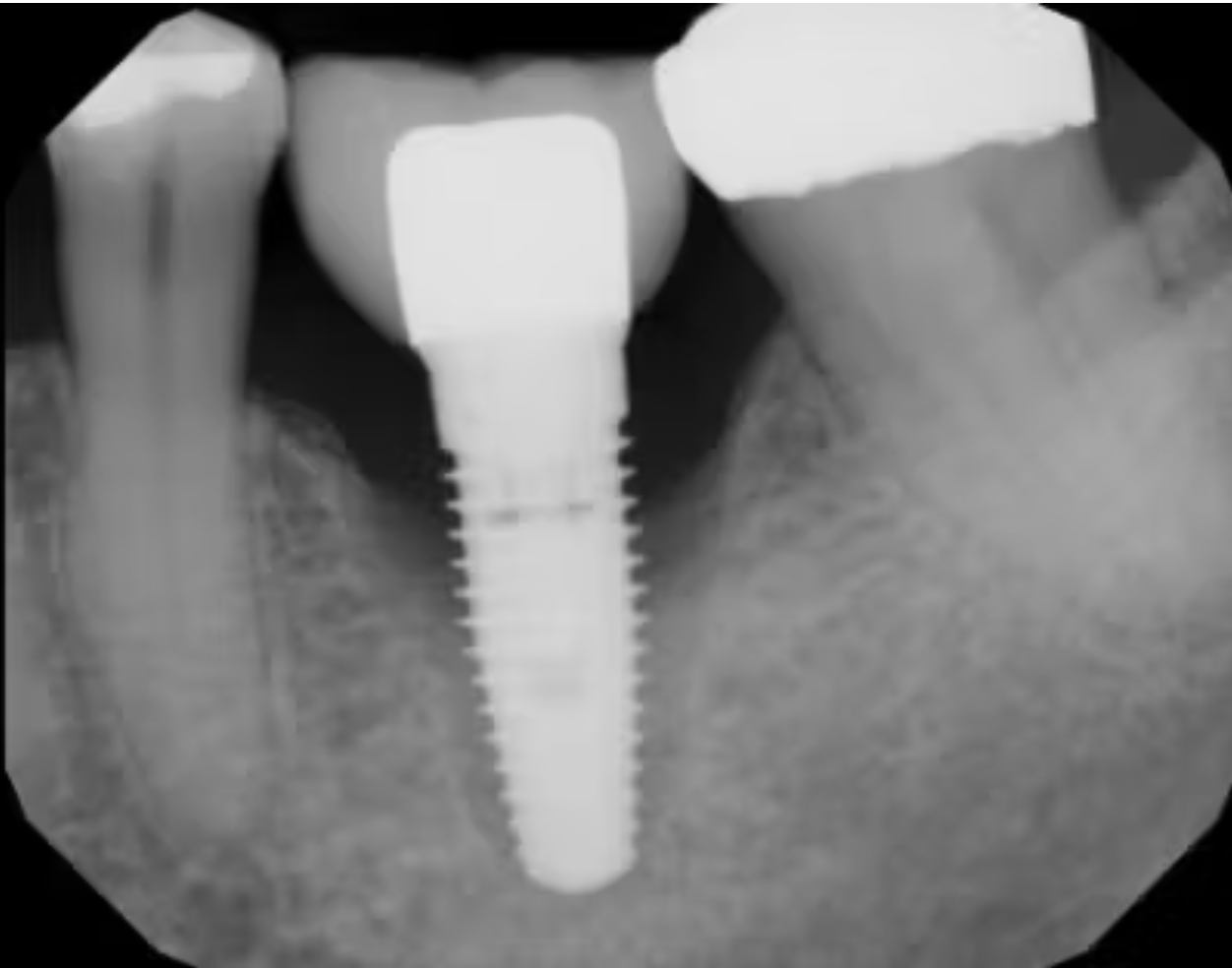 Nguyên tắc vàng khi tái cấy implant sau thất bại